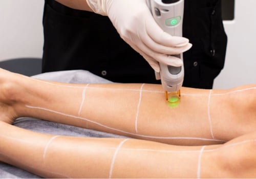 How Much Does Laser Hair Removal Cost? A Comprehensive Guide